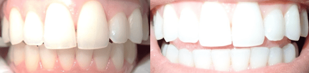 before and after image - teeth whitening