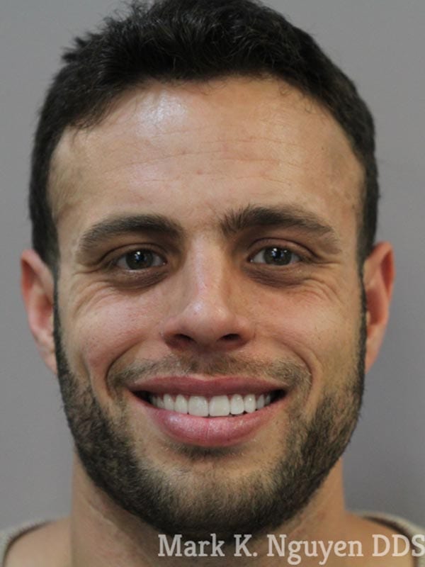 OC Healthy Smiles - After Veneers 06