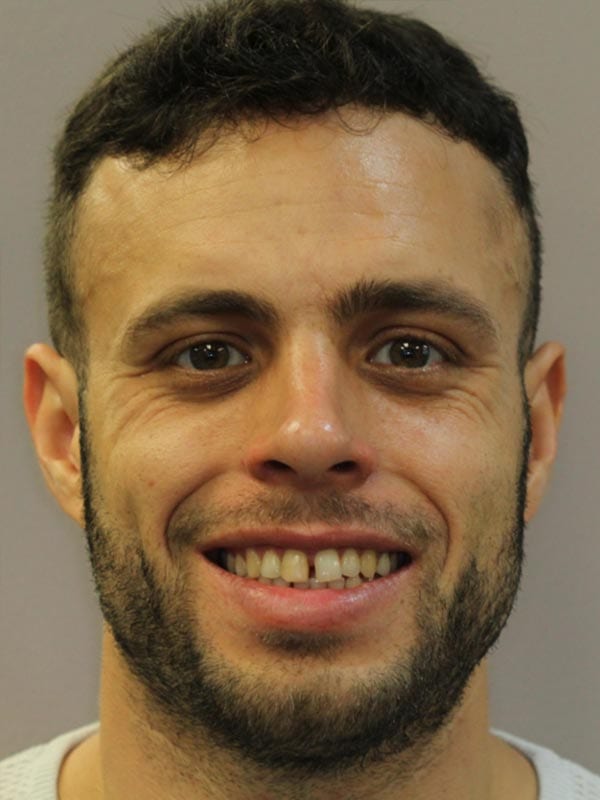 OC Healthy Smiles - Before Veneers 06